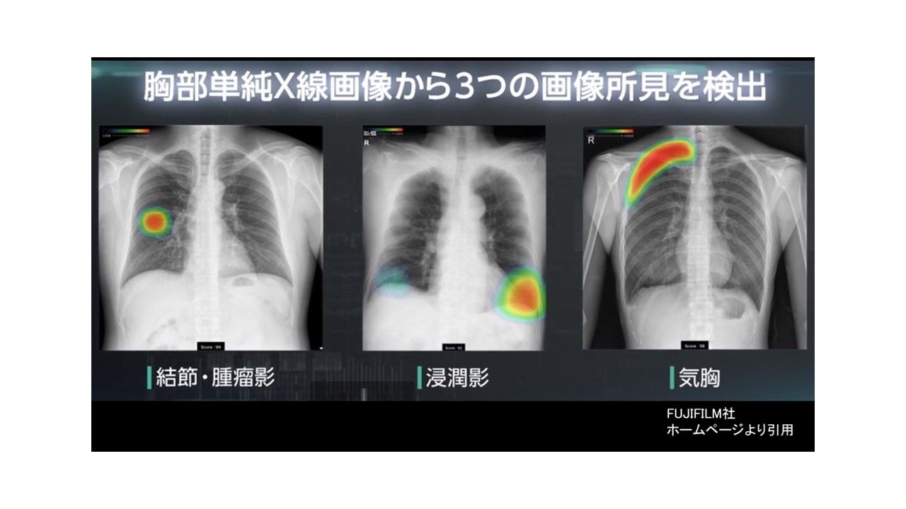 胸部 レントゲン 健康 診断